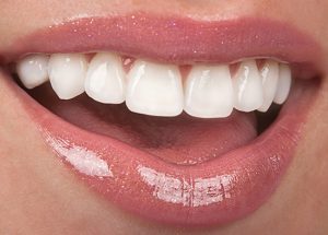 Veneers - Oro-Facial Center